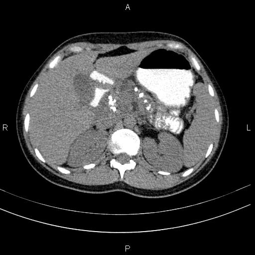 Chronic pancreatitis (Radiopaedia 64576-73450 Axial non-contrast 41).jpg