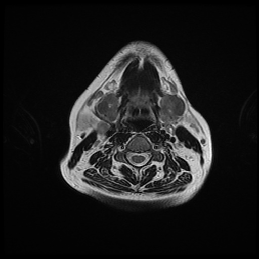 File:Chronic submandibular sialadenitis (Radiopaedia 61852-69885 Axial T2 16).jpg
