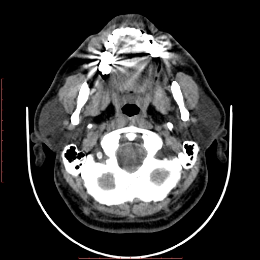 Chronic submandibular sialolithiasis (Radiopaedia 69817-79814 Axial non-contrast 50).jpg