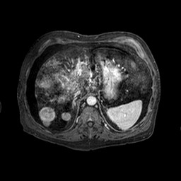 Cirrhosis and hepatocellular carcinoma in the setting of hemochromatosis (Radiopaedia 75394-86594 Axial T1 C+ fat sat 222).jpg