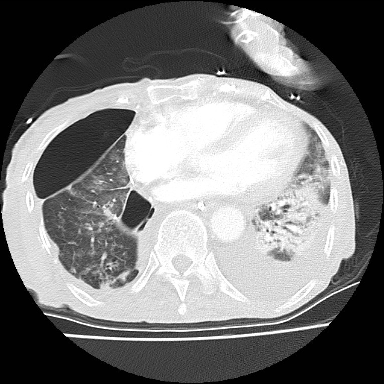 Clagett thoracotomy with bronchopleural fistula (Radiopaedia 29192-29587 Axial lung window 34).jpg