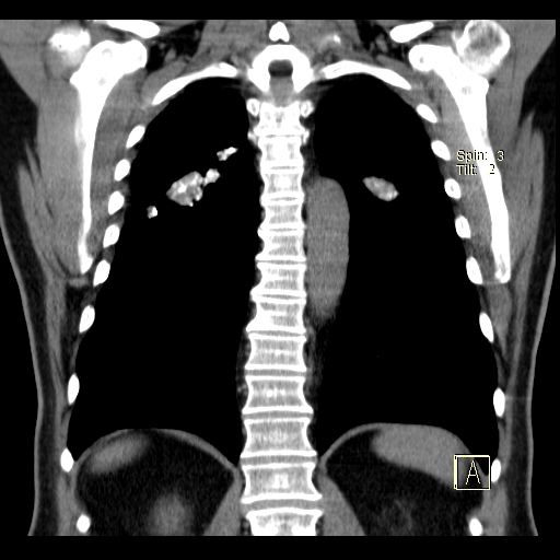 File:Classic complicated silicosis (Radiopaedia 49720-54961 Coronal liver window 45).jpg
