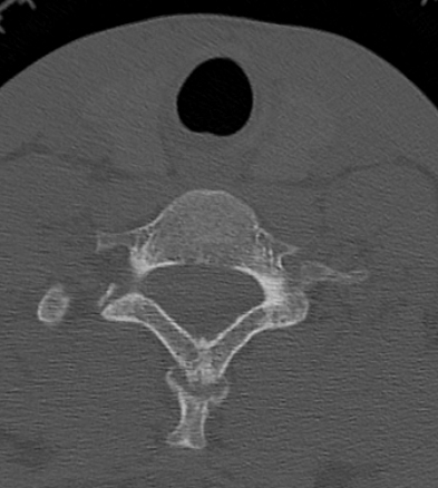 Clay-shoveler fracture (Radiopaedia 14604-14532 Axial bone window 33).jpg