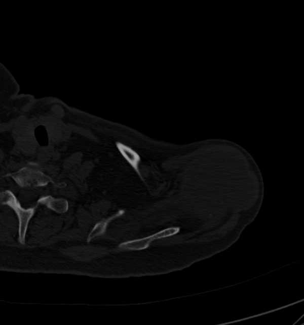 Clear cell chondrosarcoma - humerus (Radiopaedia 63104-71612 Axial bone window 18).jpg