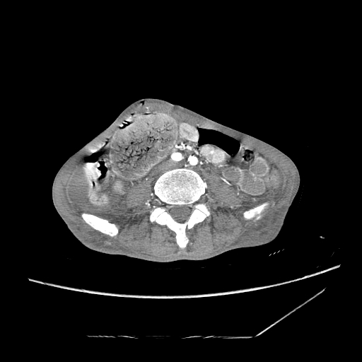 Closed-loop obstruction due to peritoneal seeding mimicking internal hernia after total gastrectomy (Radiopaedia 81897-95864 A 129).jpg