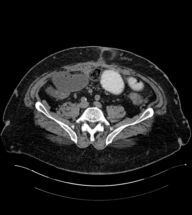 Closed-loop small bowel obstruction-internal hernia (Radiopaedia 78439-91096 Axial non-contrast 108).jpg
