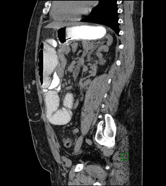 Closed-loop small bowel obstruction-internal hernia (Radiopaedia 78439-91096 C 62).jpg