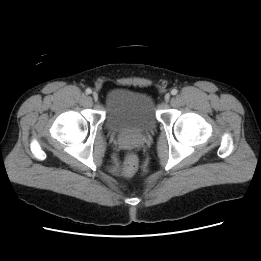 File:Closed-loop small bowel obstruction (Radiopaedia 73713-84509 A 164).jpg