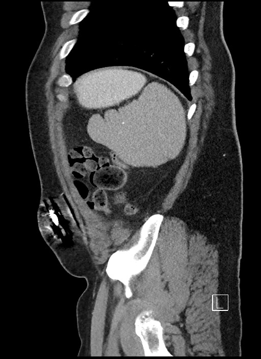 Closed loop obstruction - internal hernia into nephrectomy bed (Radiopaedia 59867-67320 C 6).jpg