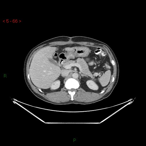 Closed loop obstruction and appendicular stump mucocele (Radiopaedia 54014-61158 A 23).jpg