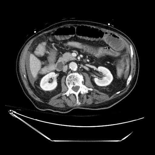 File:Closed loop obstruction due to adhesive band, resulting in small bowel ischemia and resection (Radiopaedia 83835-99023 Axial 431).jpg