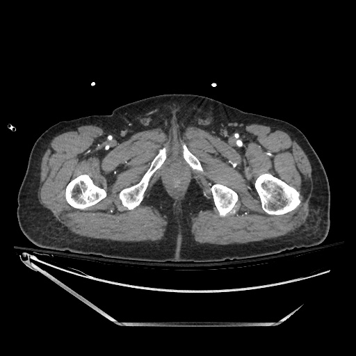 File:Closed loop obstruction due to adhesive band, resulting in small bowel ischemia and resection (Radiopaedia 83835-99023 B 164).jpg