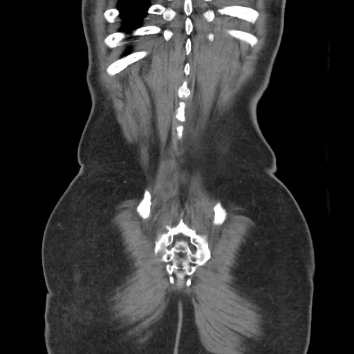 File:Closed loop obstruction due to adhesive band, resulting in small bowel ischemia and resection (Radiopaedia 83835-99023 C 113).jpg