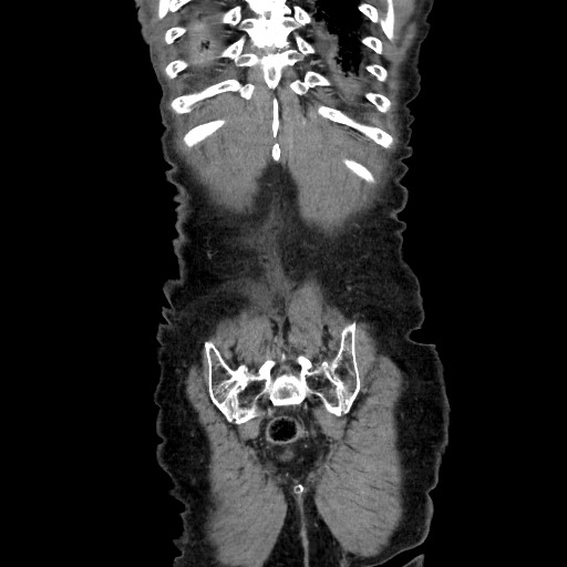 Closed loop small bowel obstruction - adhesive disease and hemorrhagic ischemia (Radiopaedia 86831-102990 B 116).jpg