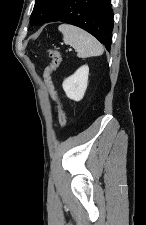 Closed loop small bowel obstruction - internal hernia (Radiopaedia 57806-64778 C 24).jpg