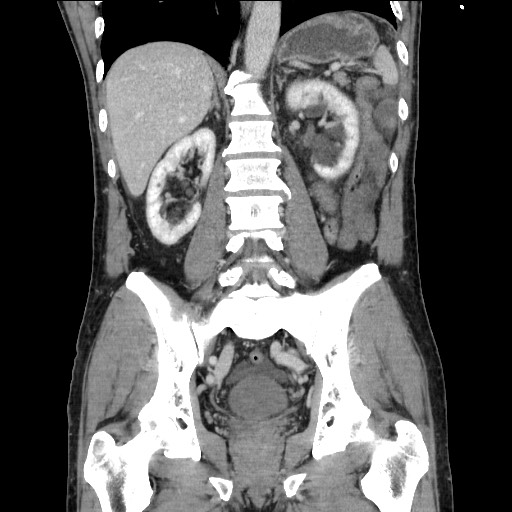 Closed loop small bowel obstruction - omental adhesion causing "internal hernia" (Radiopaedia 85129-100682 B 83).jpg