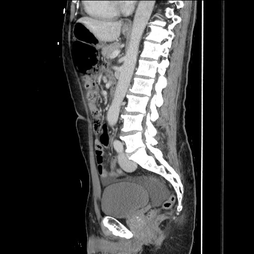 Closed loop small bowel obstruction - omental adhesion causing "internal hernia" (Radiopaedia 85129-100682 C 101).jpg