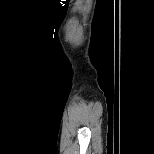 Closed loop small bowel obstruction - omental adhesion causing "internal hernia" (Radiopaedia 85129-100682 C 171).jpg