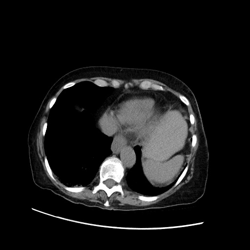 File:Closed loop small bowel obstruction due to adhesive band, with intramural hemorrhage and ischemia (Radiopaedia 83831-99017 Axial non-contrast 26).jpg