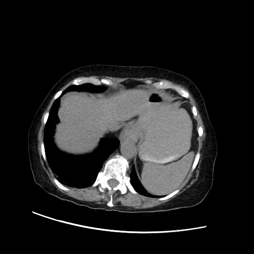 File:Closed loop small bowel obstruction due to adhesive band, with intramural hemorrhage and ischemia (Radiopaedia 83831-99017 Axial non-contrast 33).jpg