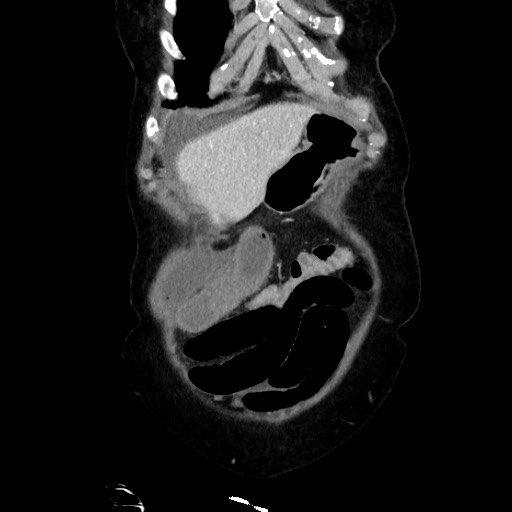 Closed loop small bowel obstruction due to adhesive band, with intramural hemorrhage and ischemia (Radiopaedia 83831-99017 C 25).jpg