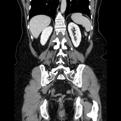 File:Closed loop small bowel obstruction due to adhesive bands - early and late images (Radiopaedia 83830-99015 B 90).jpg