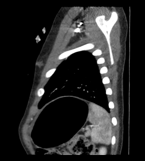 Coarctation of aorta (Radiopaedia 27427-27622 Sagittal C+ CTPA 125).png