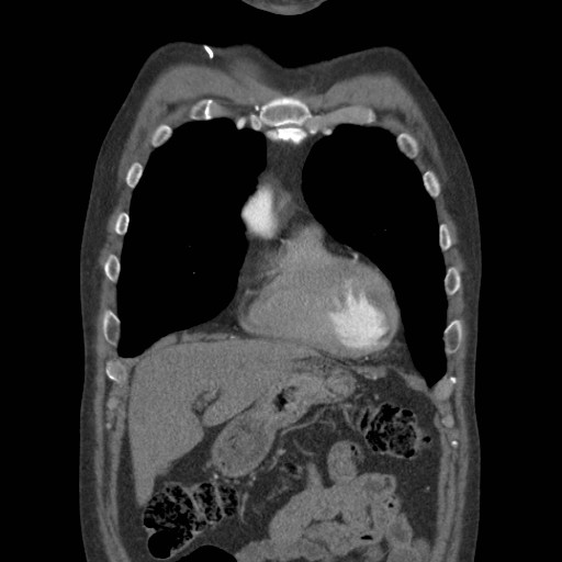 File:Coarctation of the aorta (Radiopaedia 17427-17116 A 68).jpg