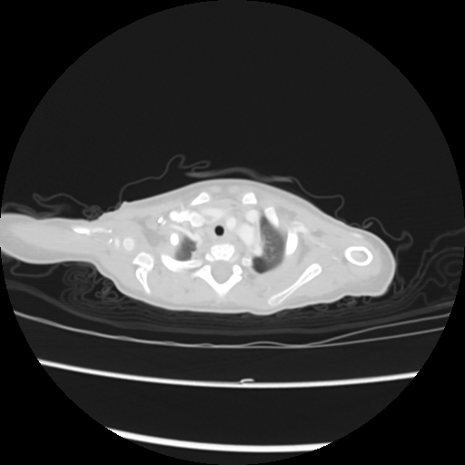 Coarctation of the aorta and patent ductus arteriosus (Radiopaedia 68033-77499 Axial lung window 2).jpg
