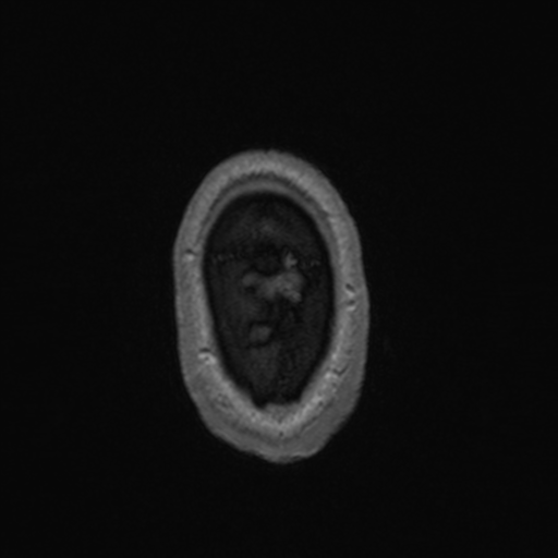 Colloid cyst (Radiopaedia 44510-48181 Axial T1 C+ 171).png