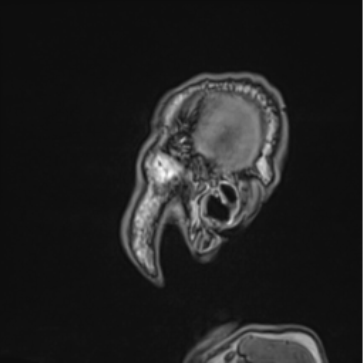 Colloid cyst of the third ventricle (Radiopaedia 86571-102662 Sagittal T1 74).png