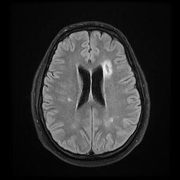 File:Colloid cyst with anterior communicating artery aneurysm (Radiopaedia 33901-35091 Axial FLAIR 16).jpg