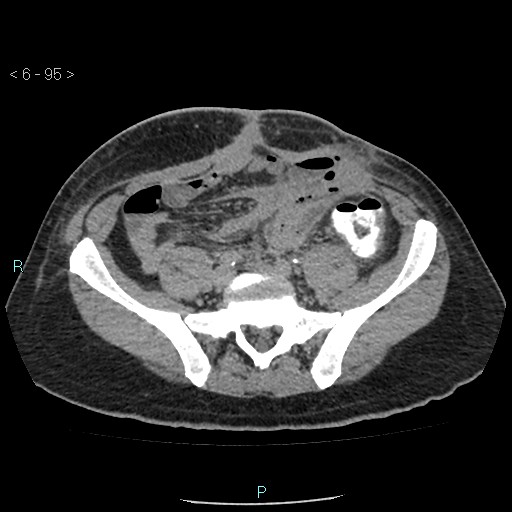 File:Colo-cutaneous fistula (Radiopaedia 40531-43129 A 39).jpg