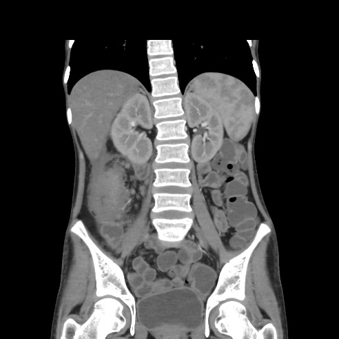File:Colocolic fistula - Crohn disease (Radiopaedia 57063-63955 B 27).jpg