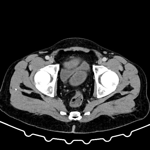 Colocolic intussusception due to large lipoma (Radiopaedia 68773-78482 A 178).jpg