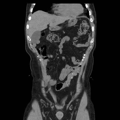 File:Colocutaneous fistula in Crohn's disease (Radiopaedia 29586-30093 Coronal non-contrast 1).jpg