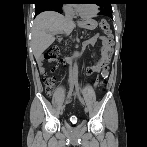 File:Colocutaneous fistula in Crohn's disease (Radiopaedia 29586-30093 E 18).jpg