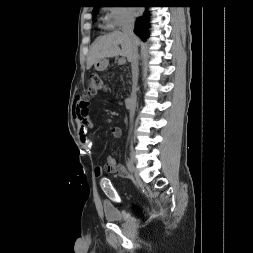Colocutaneous fistula in Crohn's disease (Radiopaedia 29586-30093 F 10).jpg