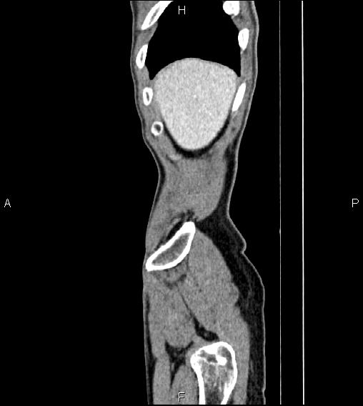 Colon adenocarcinoma - hepatic flexure (Radiopaedia 85635-101395 D 5).jpg