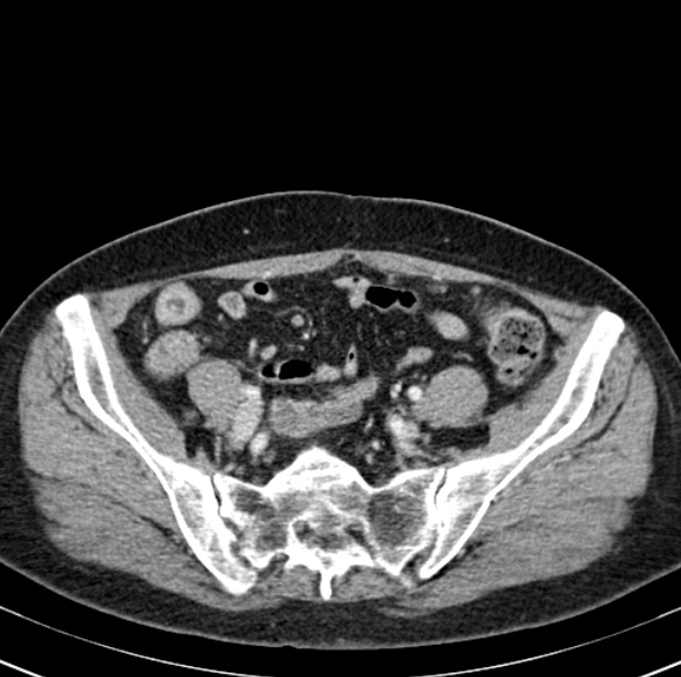 Colon carcinoma with hepatic metastases (Radiopaedia 29477-29961 A 87).jpg