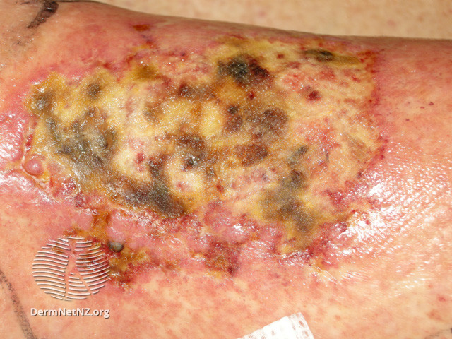 File:Cryoglobulinaemia (DermNet NZ site-age-specific-ulcer-52).jpg