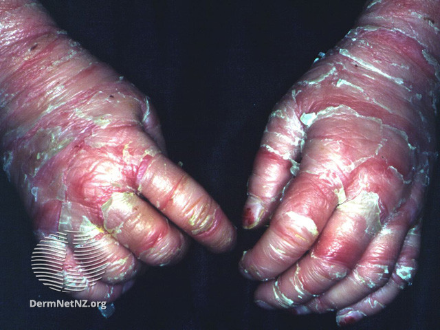 File:Epidermolytic ichthyosis (DermNet NZ scaly-ich-elytic-hk).jpg