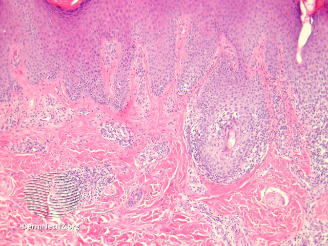 File:Figure 4 (DermNet NZ pathology-e-ilven-fig4).jpg