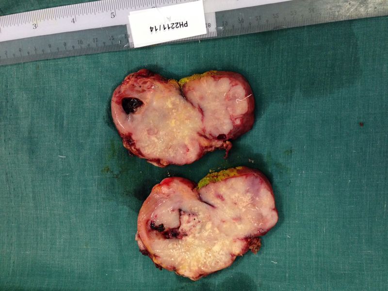 File:Gallbladder carcinoma (Radiopaedia 28787).JPG