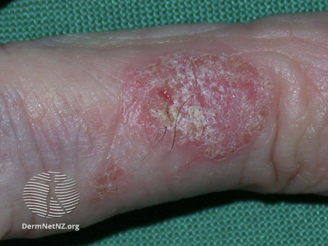 File:Intraepidermal carcinoma (DermNet NZ lesions-scc-in-situ-2970).jpg