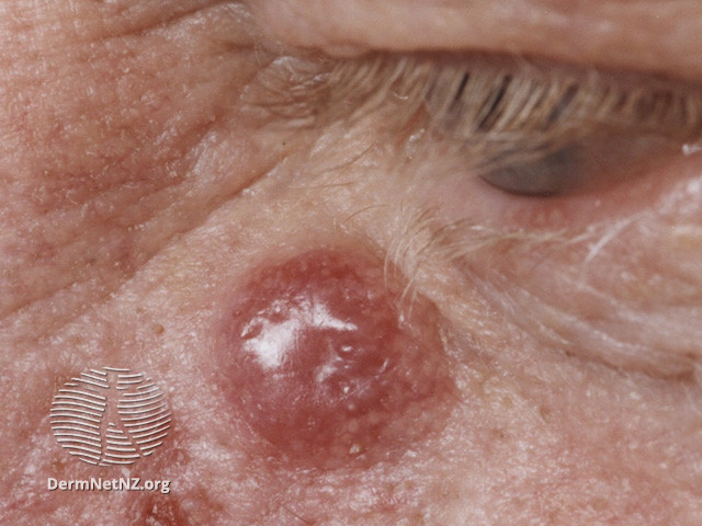 File:Merkel cell carcinoma (DermNet NZ lesions-mcc3).jpg