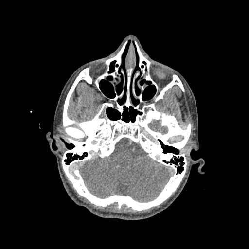 File:Nasal pyogenic granuloma (lobular capillary hemangioma) (Radiopaedia 85536-101244 C 86).jpg