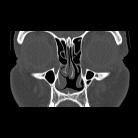 File:Nasal septal perforation (Radiopaedia 25030-25289 Coronal bone window 22).jpg
