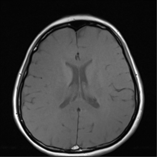 File:Nasopharyngeal carcinoma with cerebral abscess (Radiopaedia 43018-46273 Axial T1 3).png