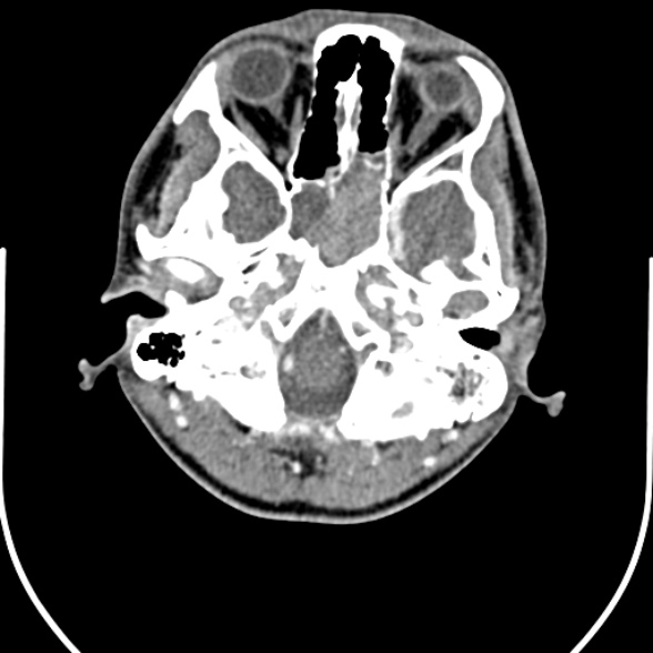 Nasopharyngeal carcinoma with skull base invasion (Radiopaedia 53415-59705 A 21).jpg